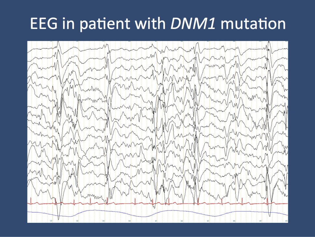 EEG of a patient with a DNM1 mutation, show slow-spike wave during an obtundation status. This EEG is the electrographic hallmark of Lennox-Gastaut Syndrome. 