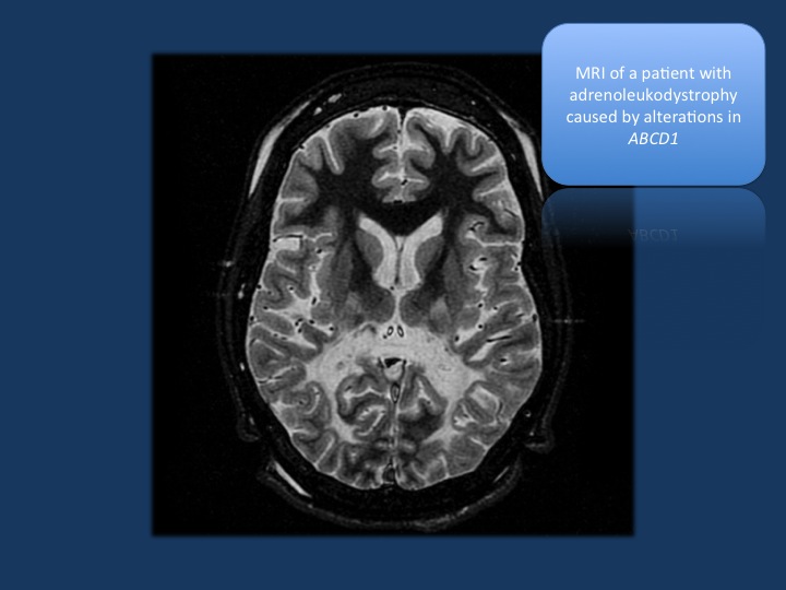 Figure 1. MRI of a patient with adrenoleukodystrophy. Leukodystrophies are genetic disorders of the white matter. Novel genetic technologies are capable of detecting causative genetic alterations in up to 75% of patients. [Image modified under a Creative Commons license from https://en.wikipedia.org/wiki/Leukodystrophy]